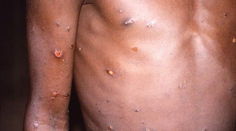 Cabo Verde reactiva plano de resposta rápida para eventual detecção do vírus Mpox