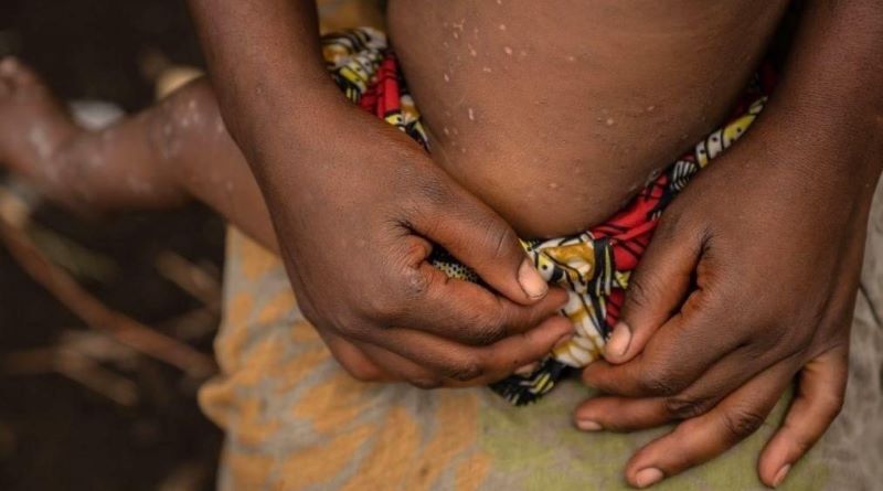 Quase um terço dos infectados com Mpox no Burundi tem menos de 5 anos, segundo a UNICEF