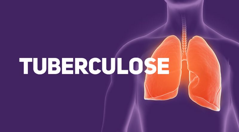 Dia Mundial da Tuberculose: Infecciologista aponta desistência dos pacientes do tratamento como desafio a vencer 